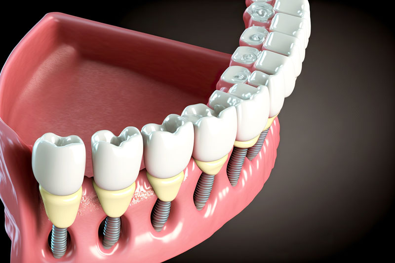 Close-up 3d model of a full right side bridge and dental implant