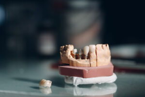 Dental layout of the human jaw with teeth and implants.