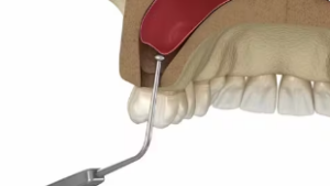 Diagrammed sinus lift procedure.