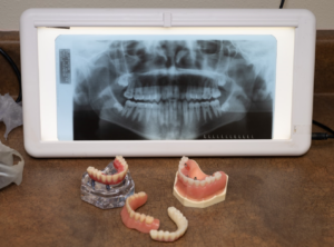 X-ray of teeth for wisdom teeth removal