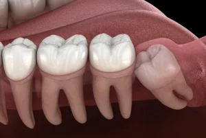 A diagram of what wisdom teeth in need of removal may look like.