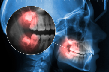 X-Ray Of Wisdom Teeth Removal
